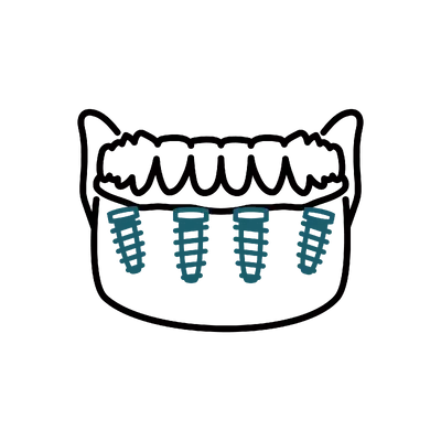 All-on-4 Dental Implants