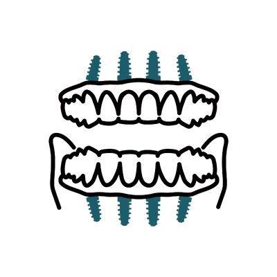 Full Mouth Implant Reconstruction