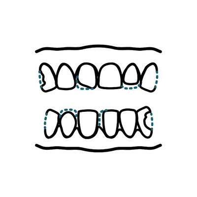 Full Mouth Reconstruction