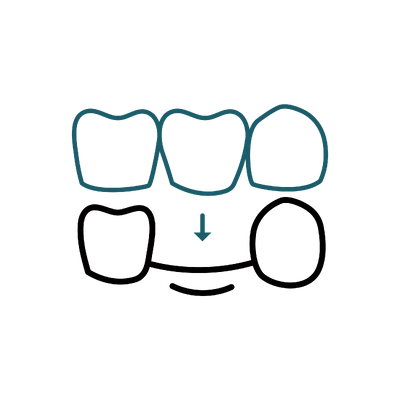 Dental Bridges in Thailand: Cost, Top Dentists & Hospitals