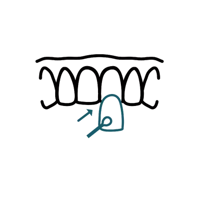 Minimal-Prep Veneers in Thailand: Cost, Top Dentists & Hospitals