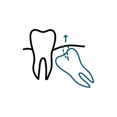 Wisdom Teeth Extraction in Thailand: Cost, Top Dentists & Hospitals