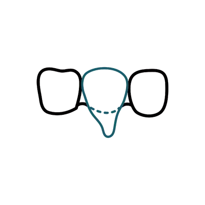 Gum Graft in Thailand: Cost, Top Dentists & Hospitals