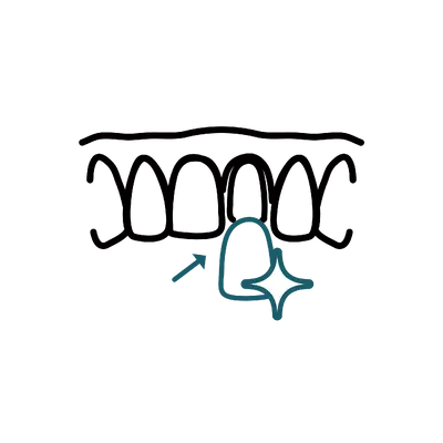 E-Max Veneers in Thailand: Cost, Top Dentists & Hospitals