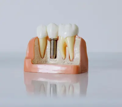 A dental implant model showing the implant screw set in the jaw
