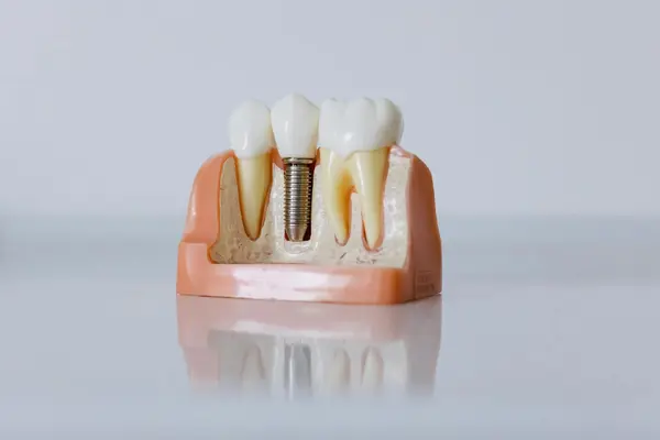 A dental implant model showing the implant screw set in the jaw